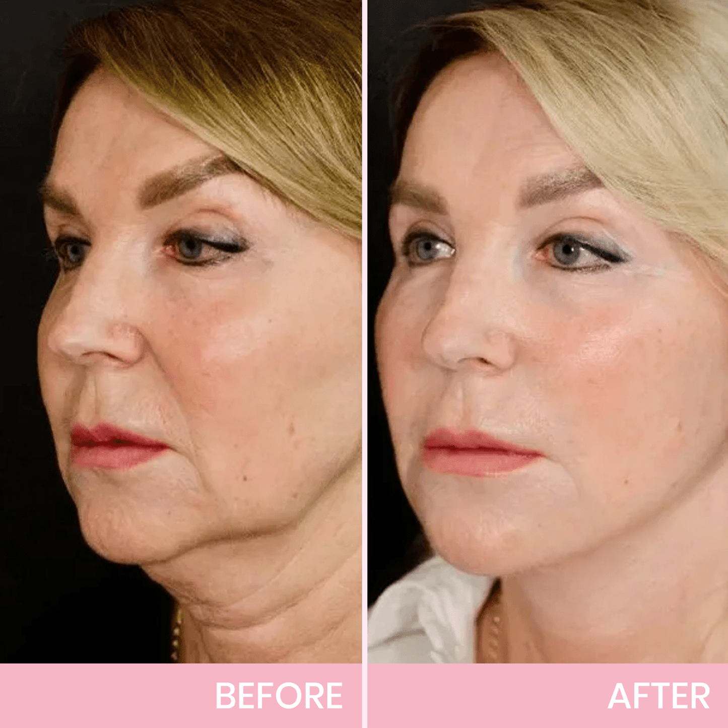 V-Face 👑 Invisible lifting tape
